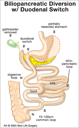 Post-Operative Diet Stages for Duodenal Switch (BPD/DS)